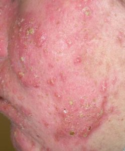 Acne Treatments For Nodular and Comedones